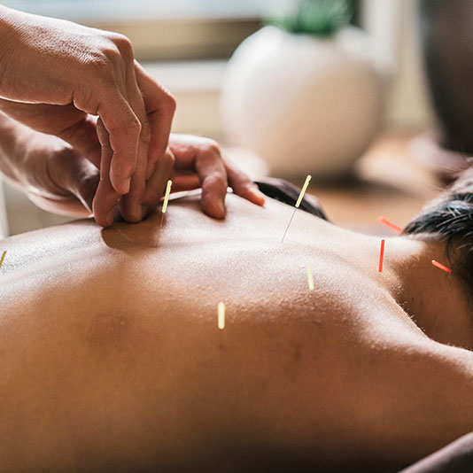 Acupuncture